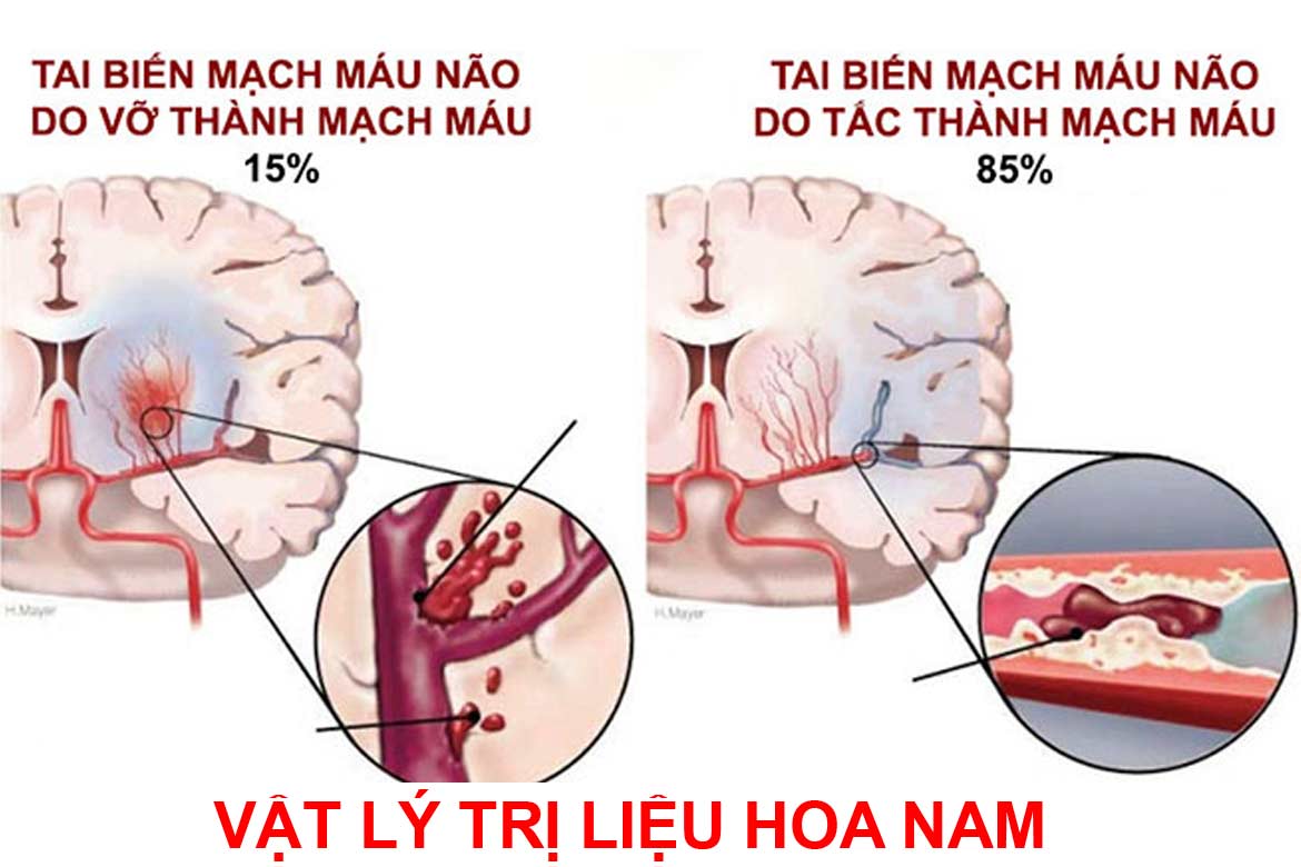 VẬT LÝ TRỊ LIỆU-PHỤC HỒI CHỨC NĂNG TAI BIẾN MẠCH MÁU NÃO